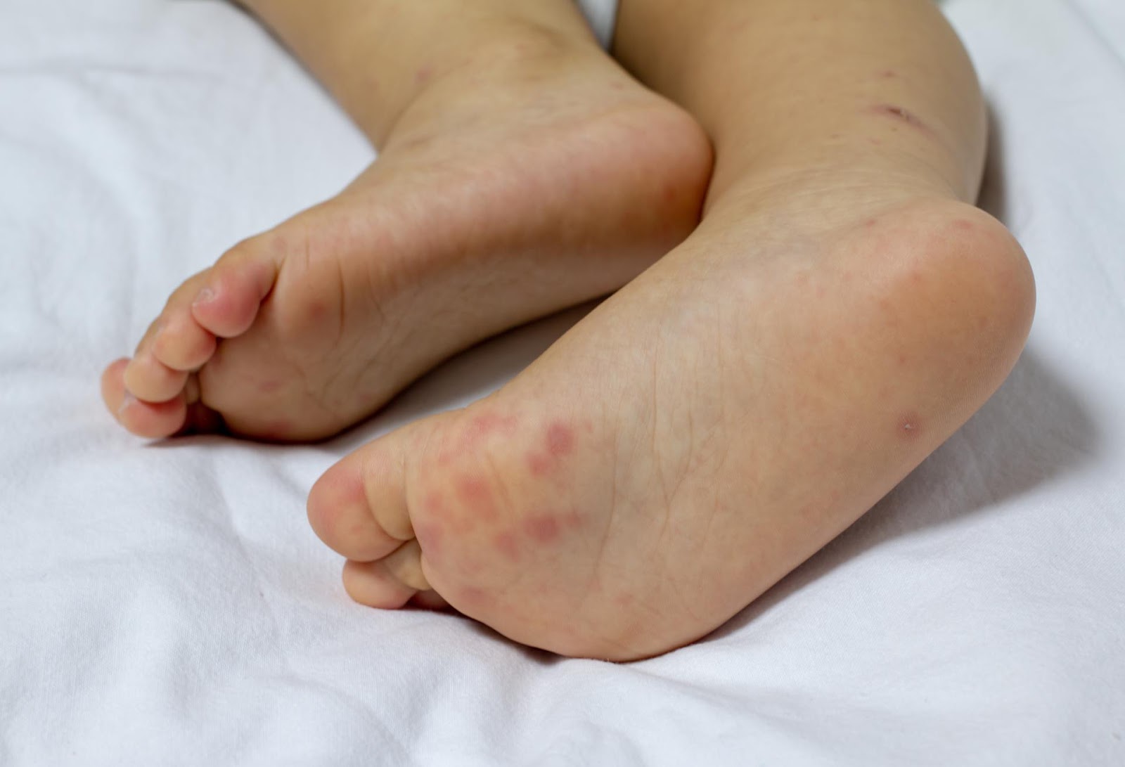 手足口病来势汹汹，有这份指南，就一点都不可怕|手足口病|感染者|传染源|指南|病毒|儿童|-健康界
